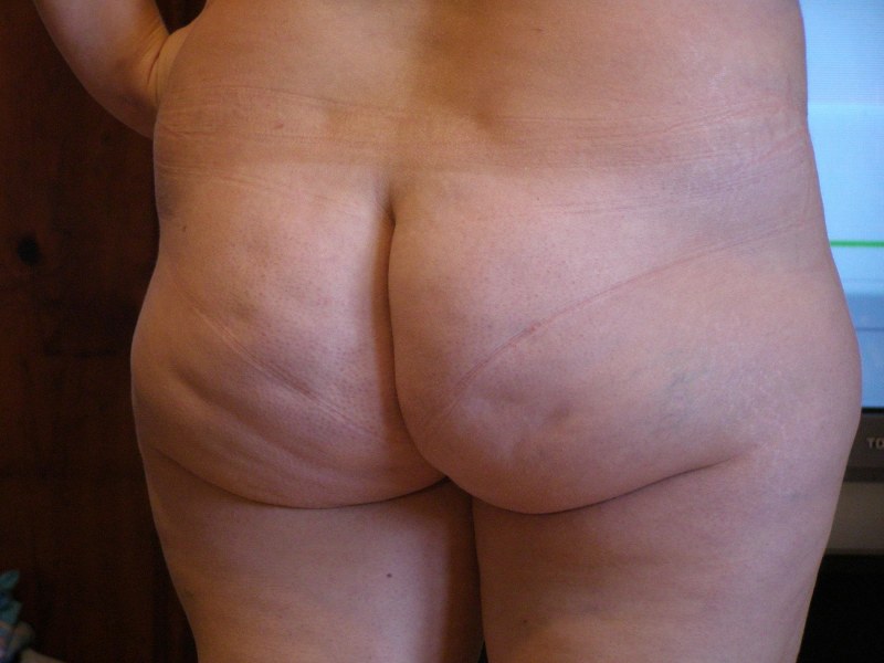 Old elderly with cellulite