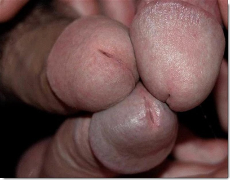 The exposure of the head of the penis