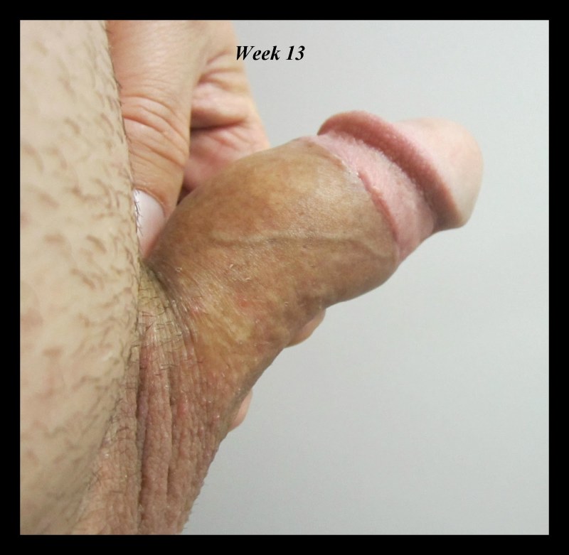 Naked Penis Before and after Circumcision