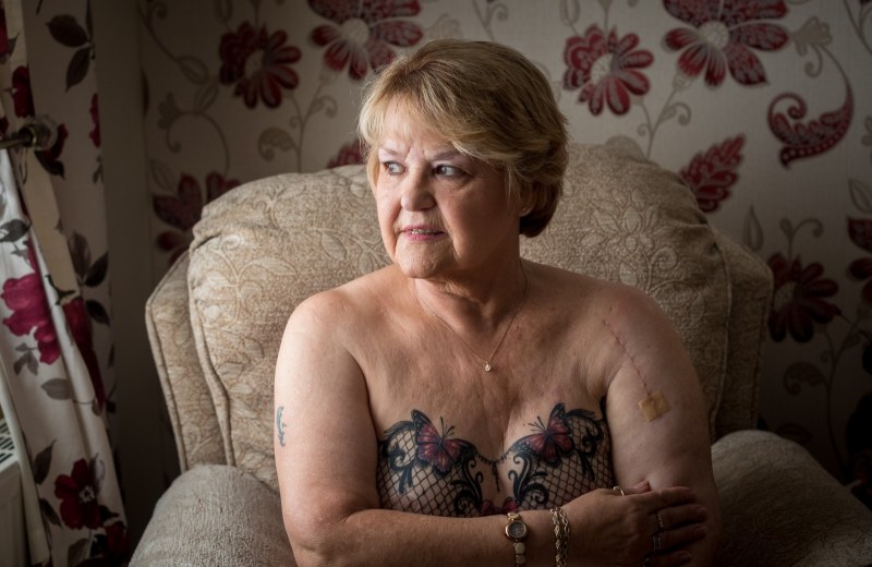 Fascia muscles and topography of the upper limb