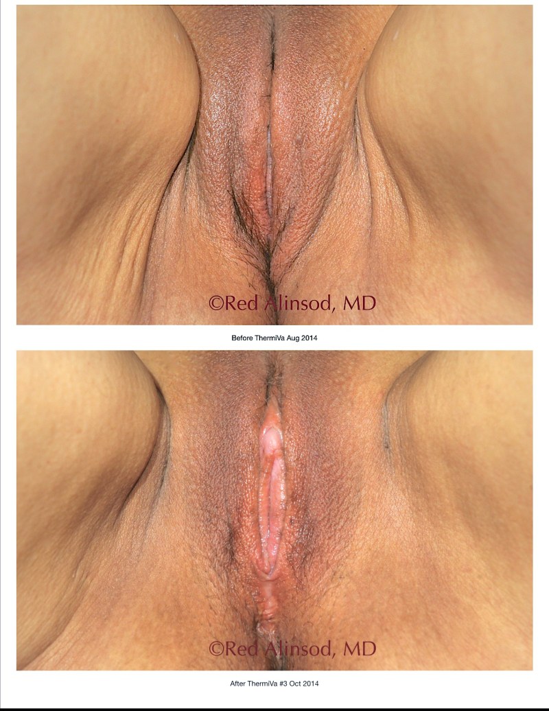 Selfie pussies after childbirth