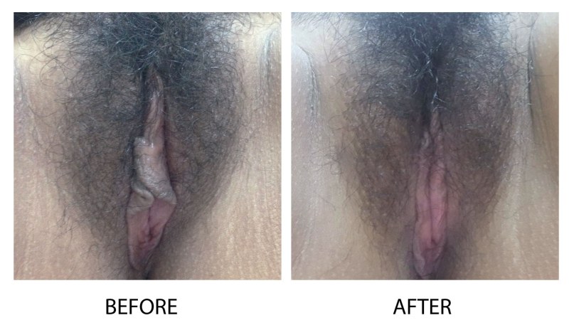 Sexchange Surgery Photos Before and After