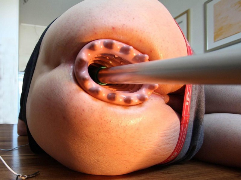 Unusual objects in the anus