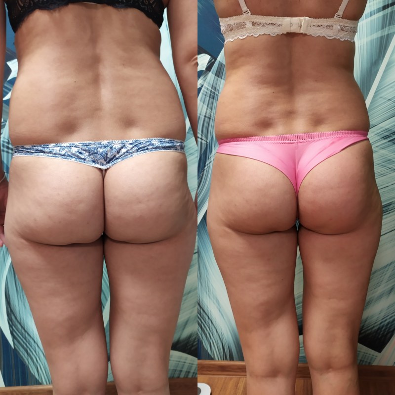 Swimsuit for cellulite women