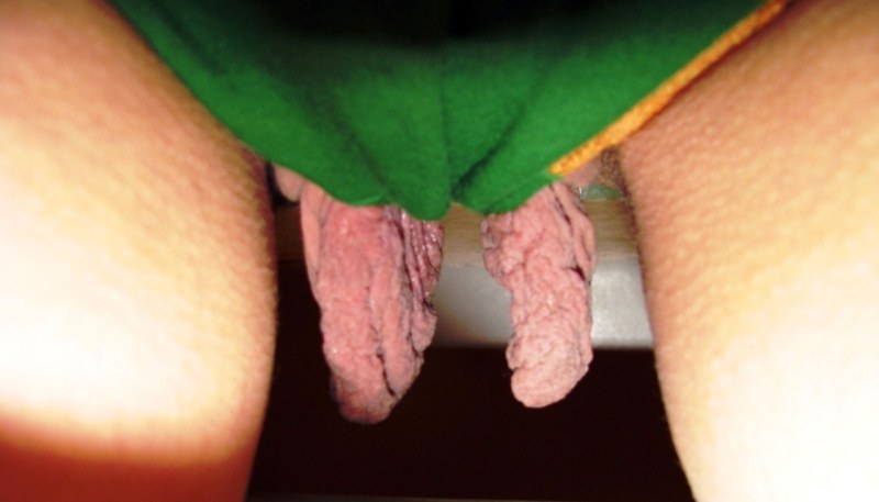 Long hanging labia