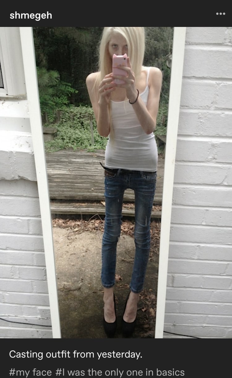 Guys before and after anorexia