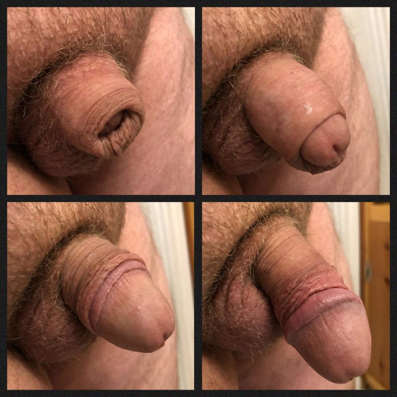 FIRST CUMSHOT MASTURBATION AFTER CIRCUMCISION GAY