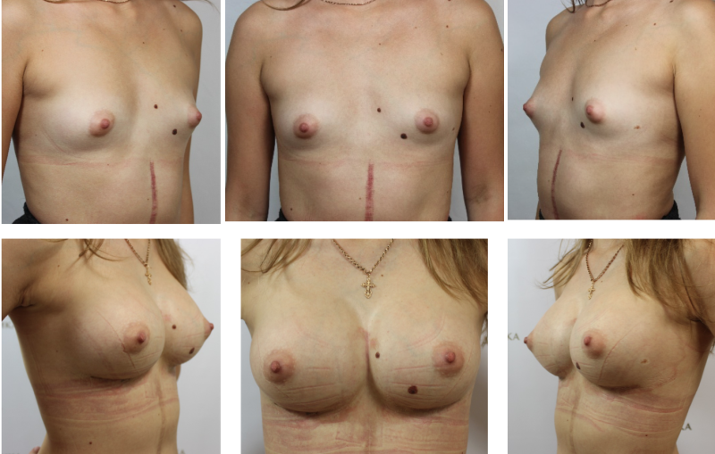 Naked breasts of different shapes