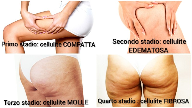 Weyergans Cellulite
