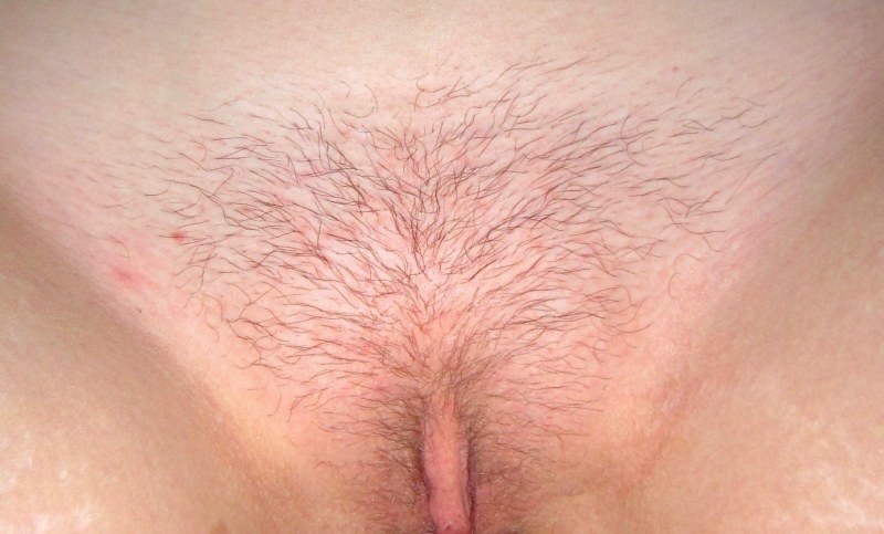 Pubic hair in women