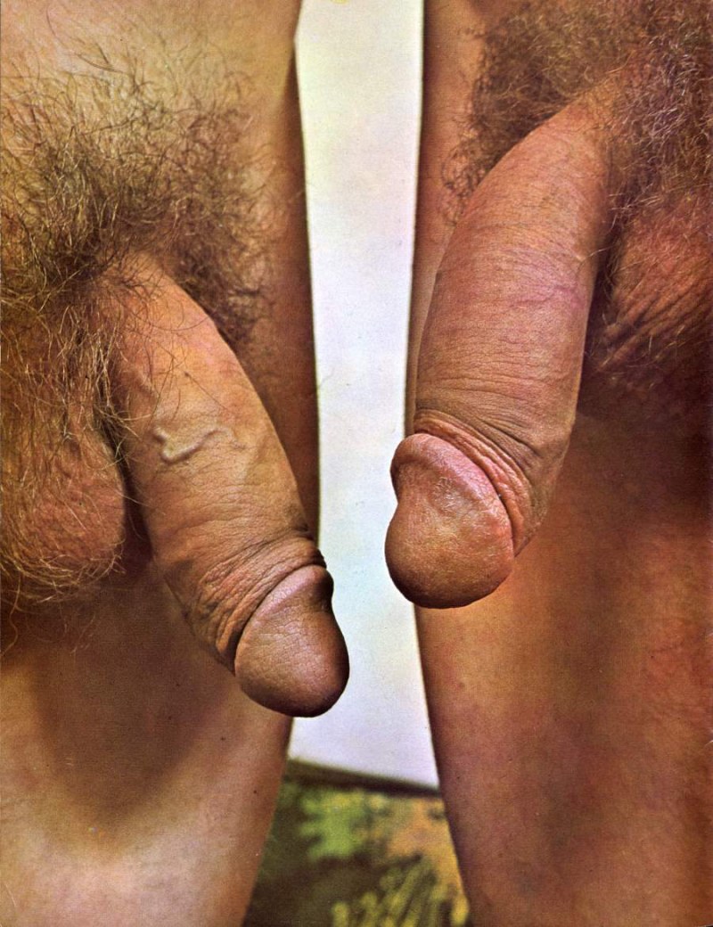 Diphallia photo two penis masturbation