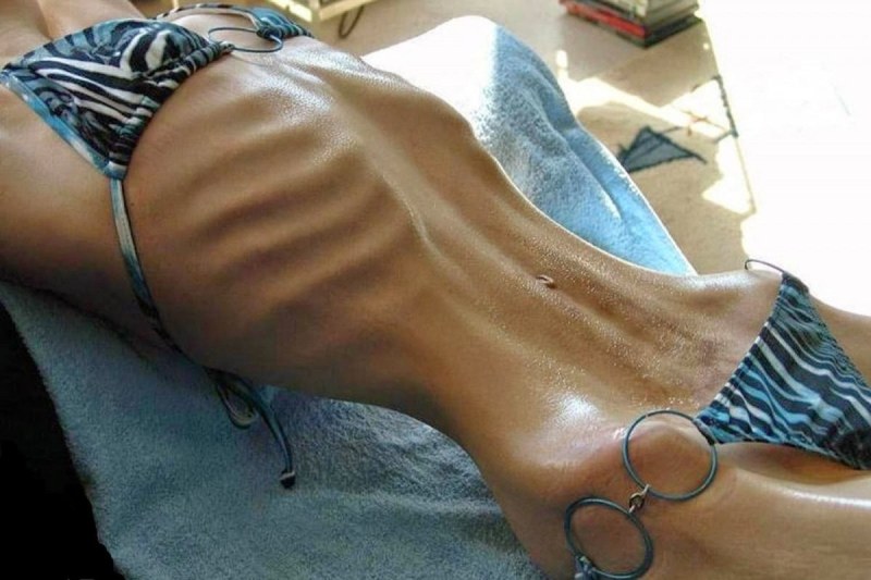 Anorexia among models