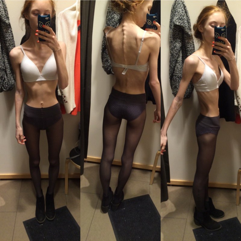 Victoria Prikhodko anorexia