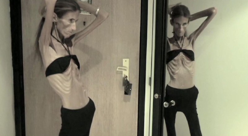 Dismorphomanic anorexia