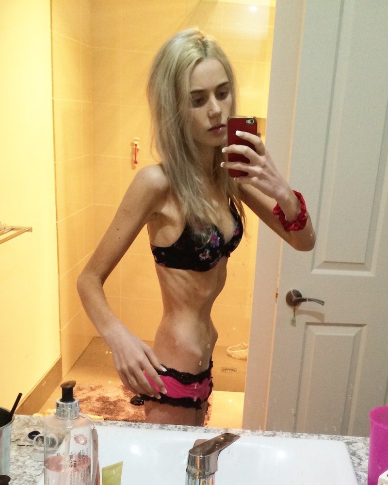 Anorexica Julia Stoletova