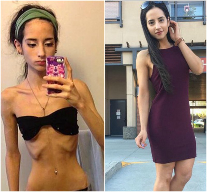 Beautiful girls with anorexia