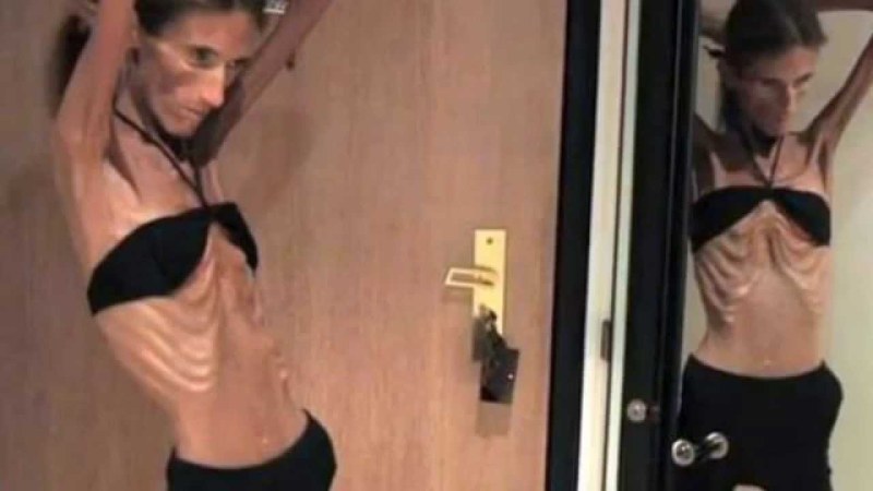 Skinny flexible anorexics