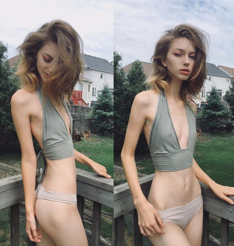 Sarah Spencer Anorexia