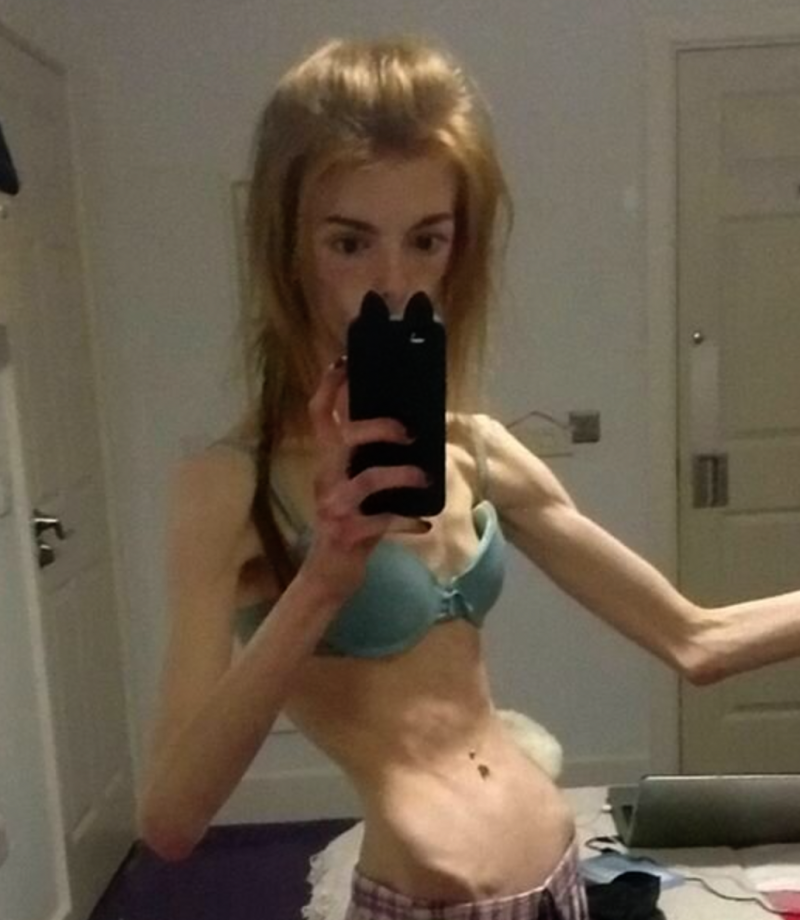 Jeremy Glizer Anorexia