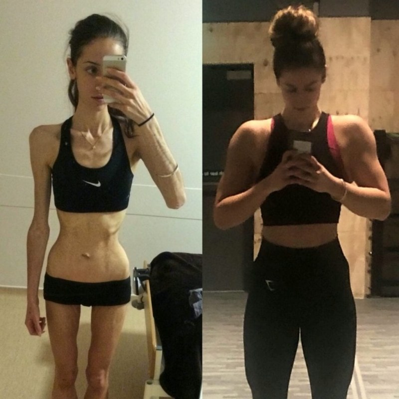 Alina Zakharenkova anorexia