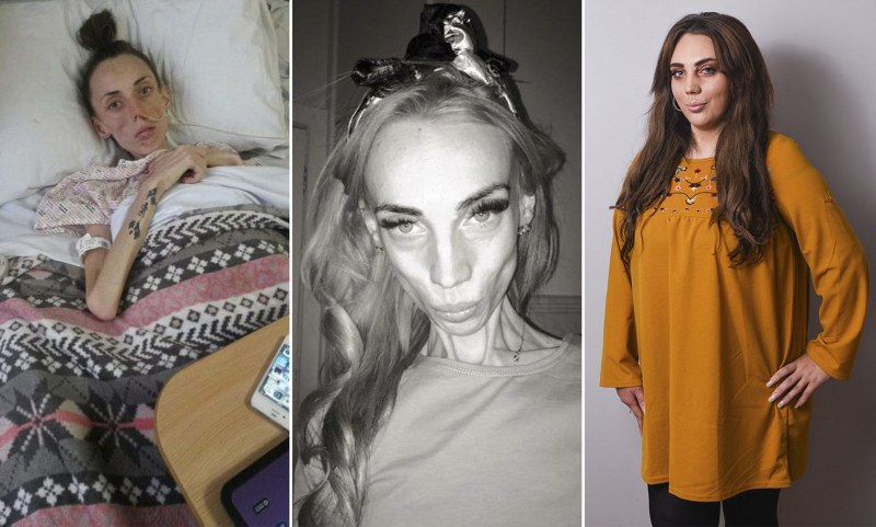 Medical infographics of anorexia