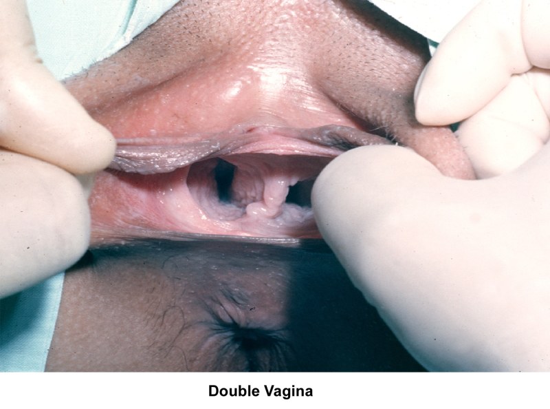 Hazel Jones with two vaginas