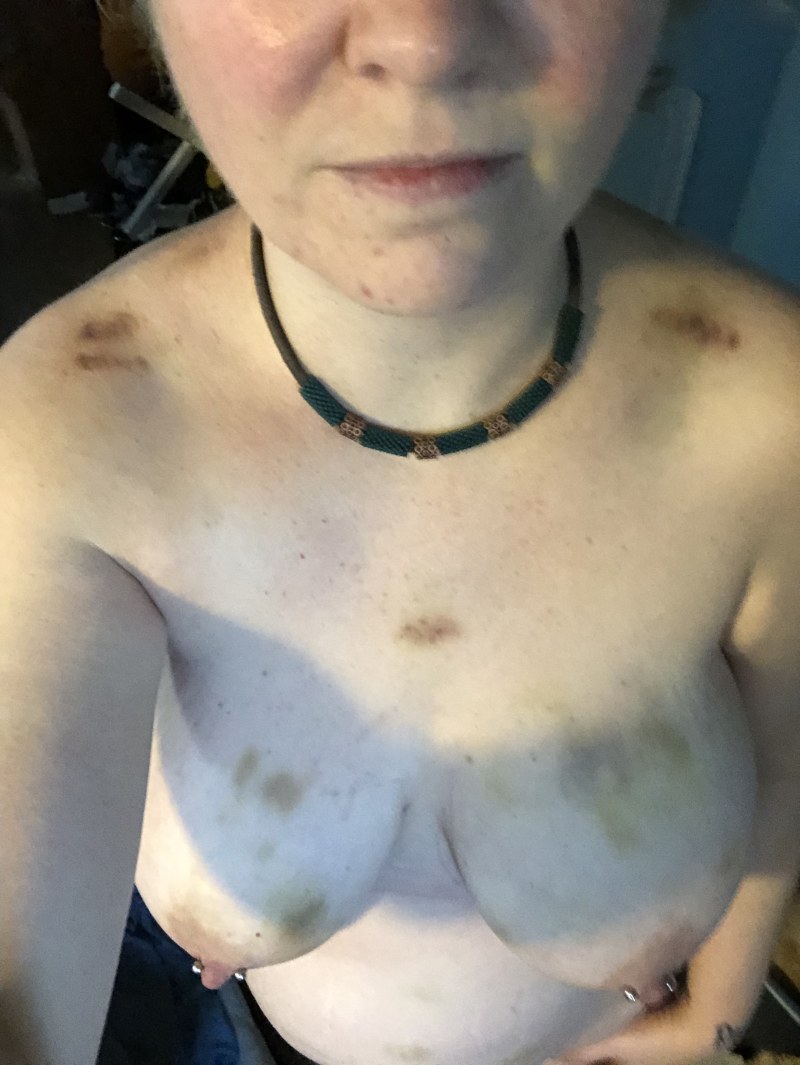 Big breasts in bruises