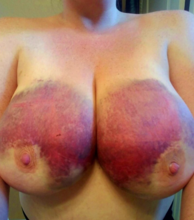 Big Women's Tits in Bruises