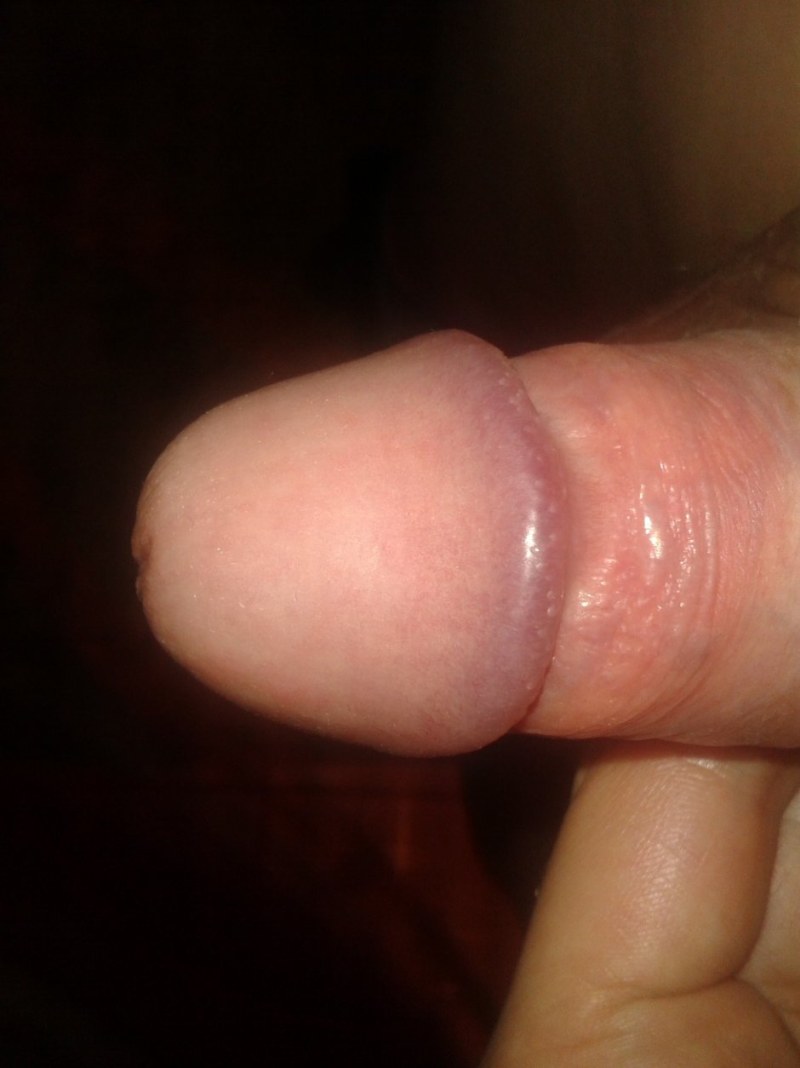 Red spots on the head of the penis