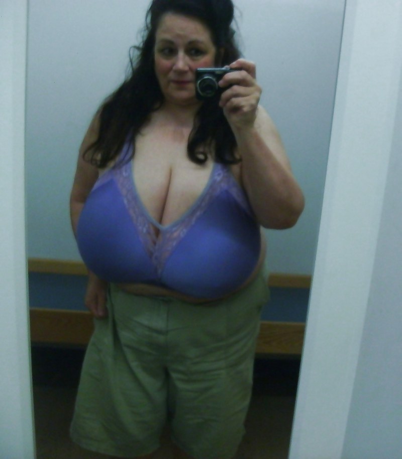 Gigantomastia (hypermastia, macromastia)